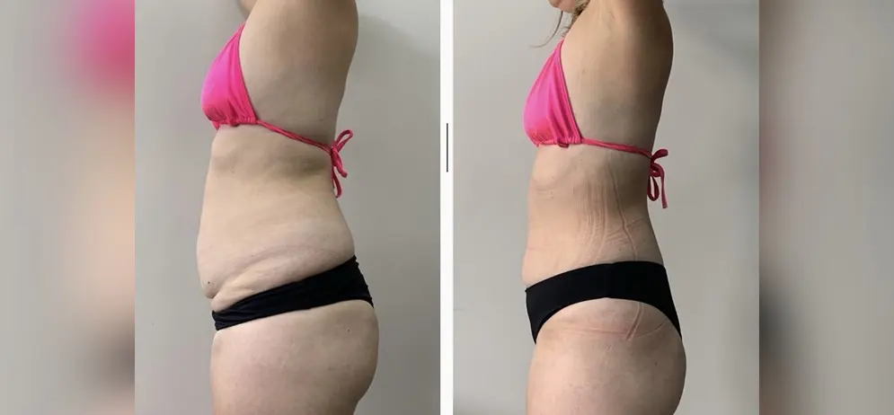 Antes e depois 1